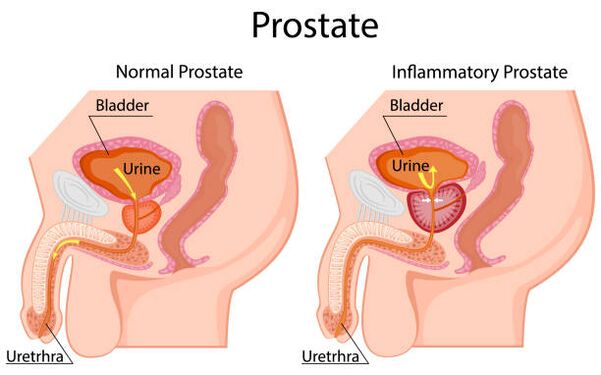 healthy and inflamed prostate