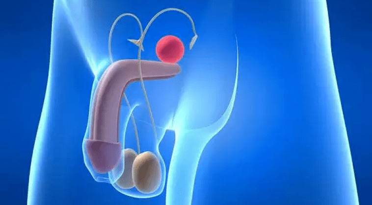 Prostatitis is an inflammation of the prostate gland in men, requiring complex treatment